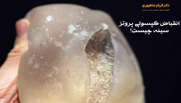 انقباض کپسولی پروتز سینه