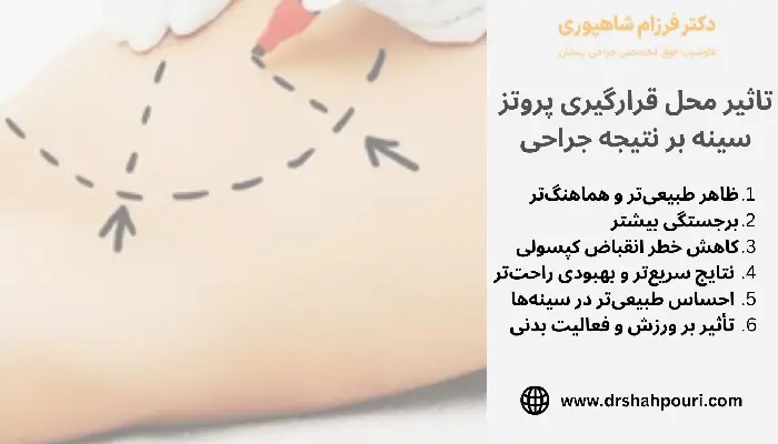 محل قرار گیری پروتز سینه