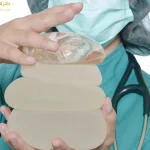 جابه جایی پروتز سینه