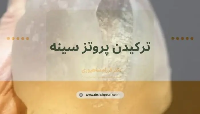 ترکیدن پروتز سینه
