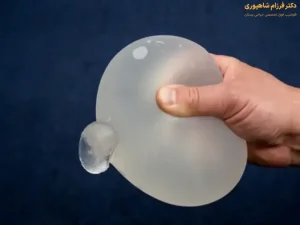 ترکیدن پروتز سینه