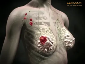 سرطان سینه بدخیم