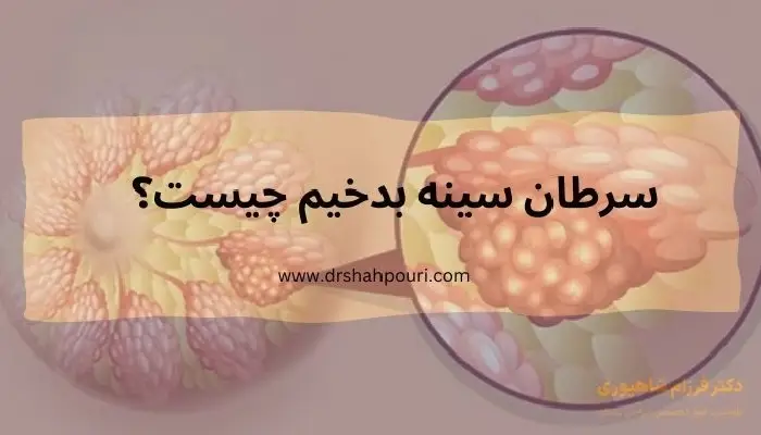 سرطان سینه بدخیم