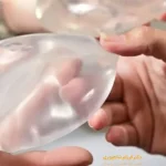 پروتز سینه و شیردهی