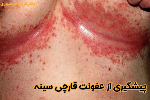 پیشگیری از عفونت قارچی‌ سینه
