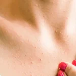 تغییرات پوستی سرطان سینه
