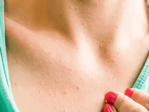 تغییرات پوستی سرطان سینه