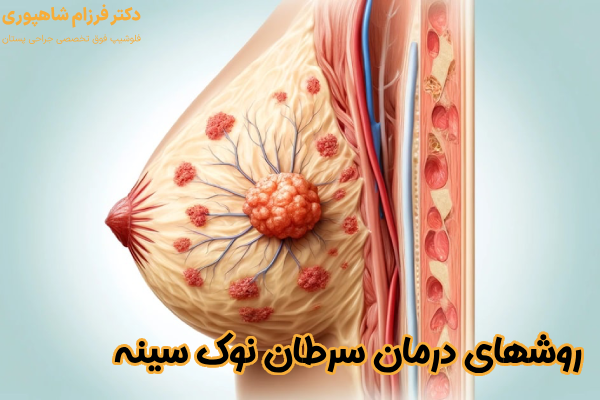 روشهای درمان سرطان نوک سینه