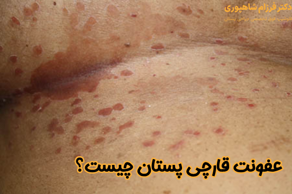 عفونت قارچی سینه چیست