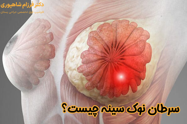 سرطان نوک سینه چیست