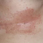 عفونت قارچی سینه