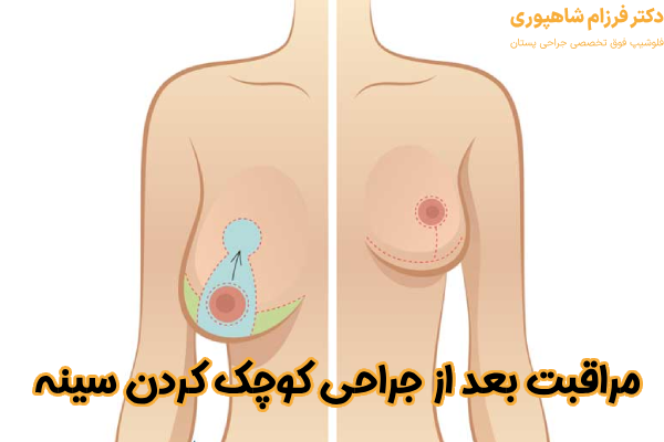 مراقبت بعد از جراحی کوچک کردن سینه