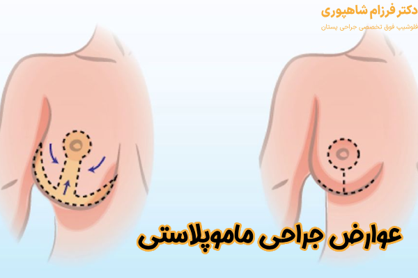 عوارض جراحی ماموپلاستی