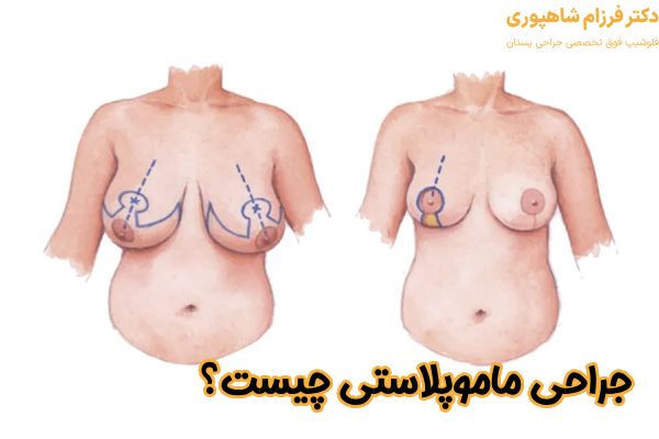 جراحی ماموپلاستی چیست؟