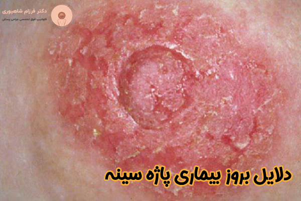 دلایل بروز بیماری پاژه سینه