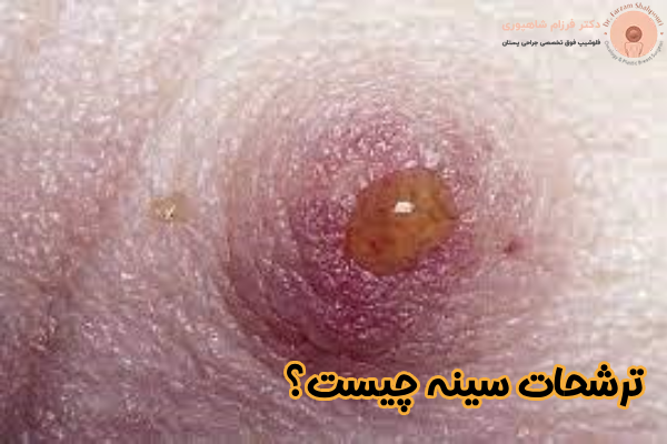 ترشحات سینه چیست؟
